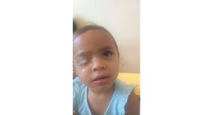 Read more about the article Menina de 2 anos passa por procedimento após grudar olho com cola instantânea no DF
