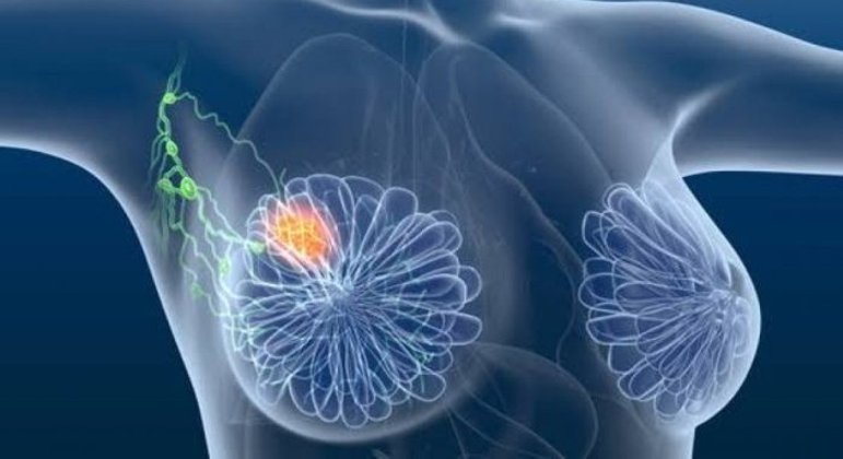 You are currently viewing Tratamento inovador elimina totalmente o câncer de mama em estágio inicial 