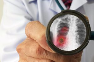 Read more about the article Qual a diferença entre pneumonia bacteriana e viral?