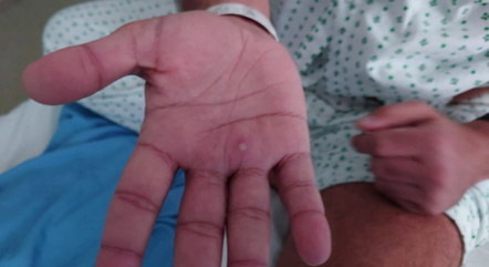 You are currently viewing Prefeitura descarta caso de varíola do macaco em bebê de Contagem, na Grande BH