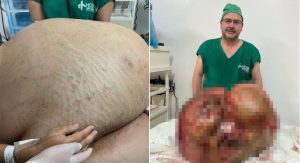 Read more about the article Paciente que removeu tumor de 46 kg morre 11 dias após cirurgia