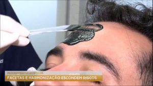 Read more about the article Harmonização facial e facetas nos dentes escondem riscos