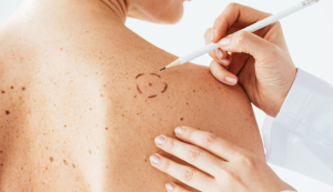 Read more about the article Dermatologista ensina quais são os sinais de alerta e sintomas do Câncer de Pele