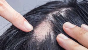 Read more about the article Saiba como tratar a alopecia areata utilizando apenas 3 ingredientes