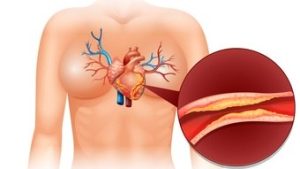 Read more about the article Novo método poderá mostrar com precisão quem está prestes a ter um infarto ou AVC