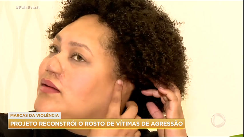 You are currently viewing Projeto gratuito ajuda vítimas de violência doméstica a reconstruir o próprio rosto
