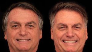 Read more about the article Bolsonaro faz procedimento estético em clínica de Goiânia; veja antes e depois