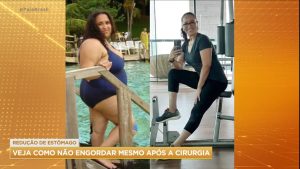 Read more about the article Saiba como não engordar após fazer a cirurgia de redução de estômago